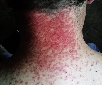 Comment éviter les problèmes causés par la chenille processionnaire